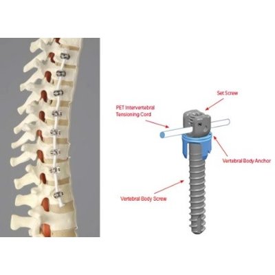 The first system for the internal scoliosis correction has been approved